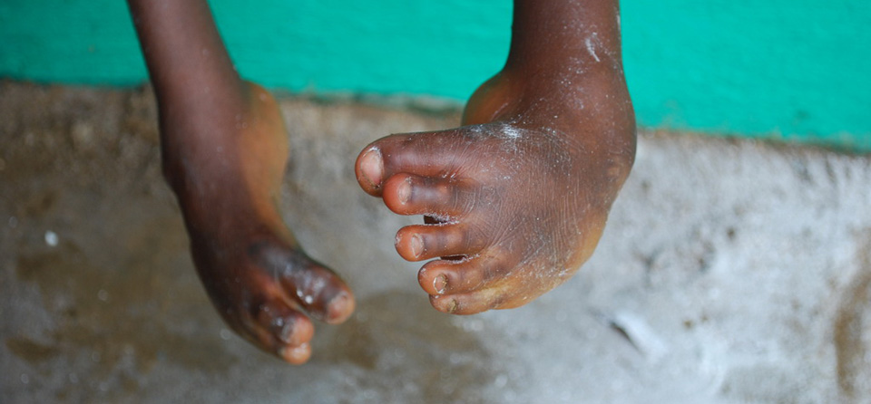 Curing Clubfoot:  Project Redwood Grantee MiracleFeet In The News